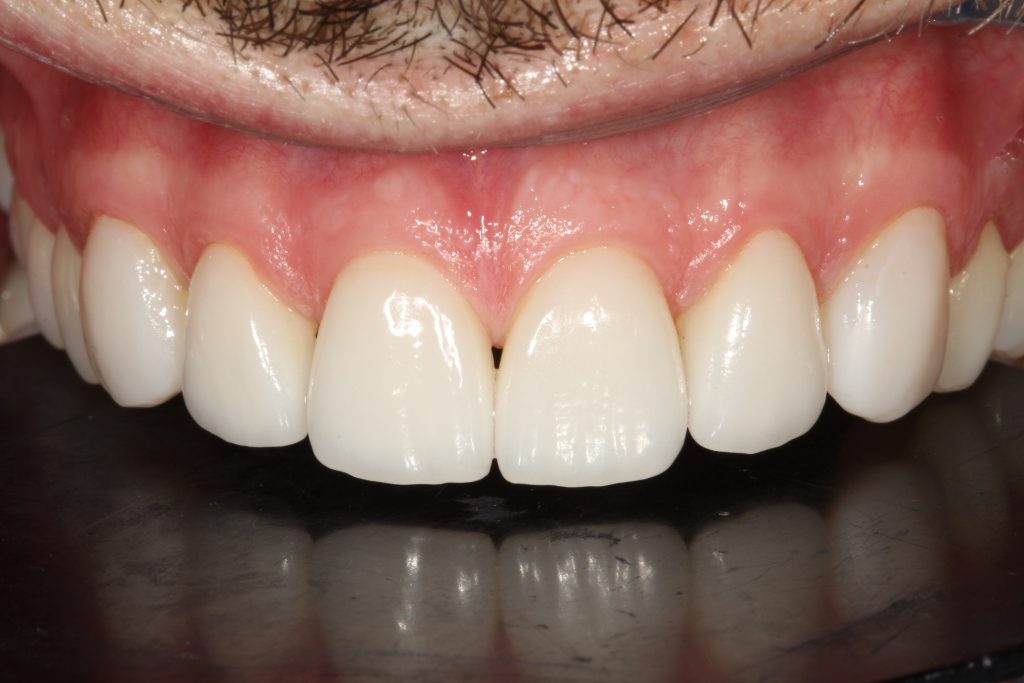 After Veneers