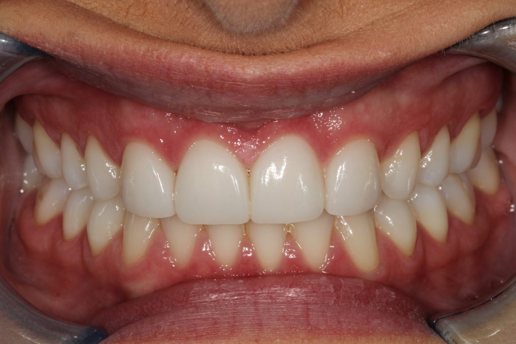 After Veneers