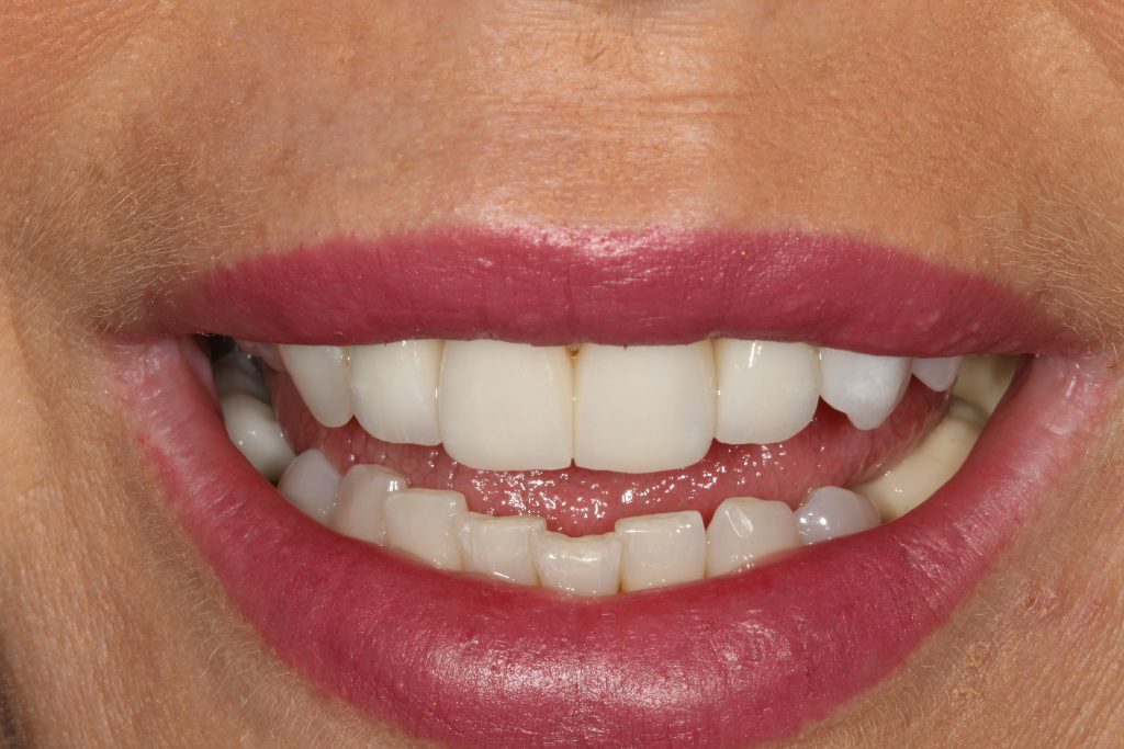 After Veneers