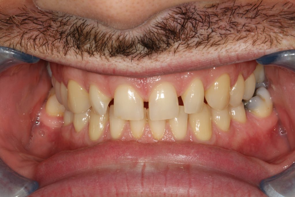 Before Veneers