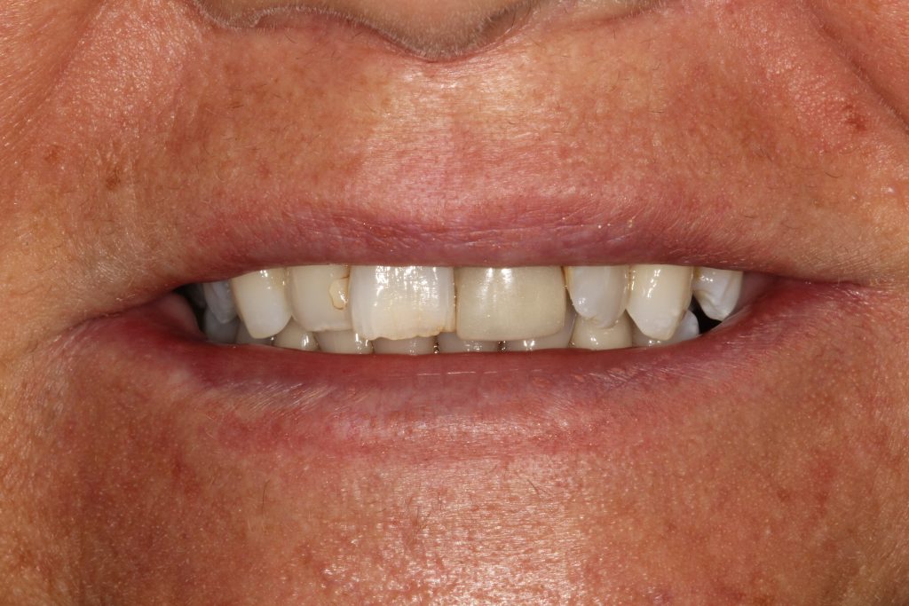 Before Veneers