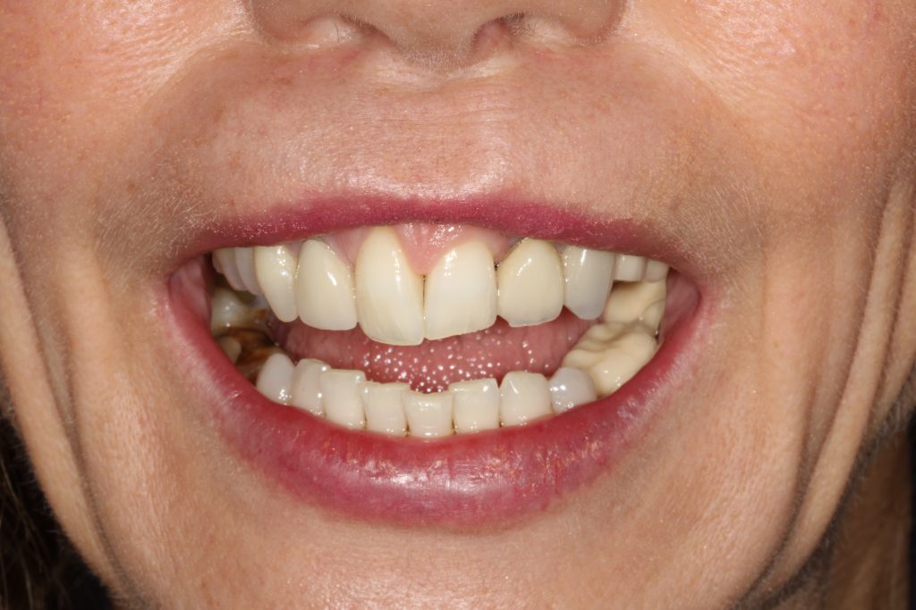 Before Veneers