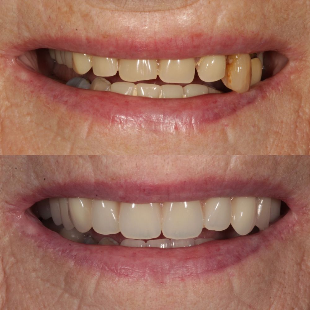 Before and after treatment at St Andrews Dental Care in Fife