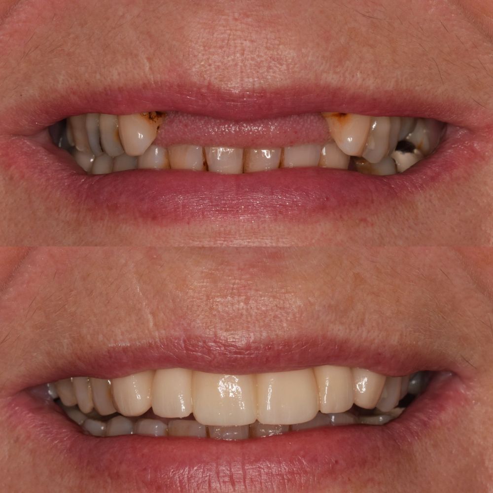 Before and after treatment at St Andrews Dental Care in Fife