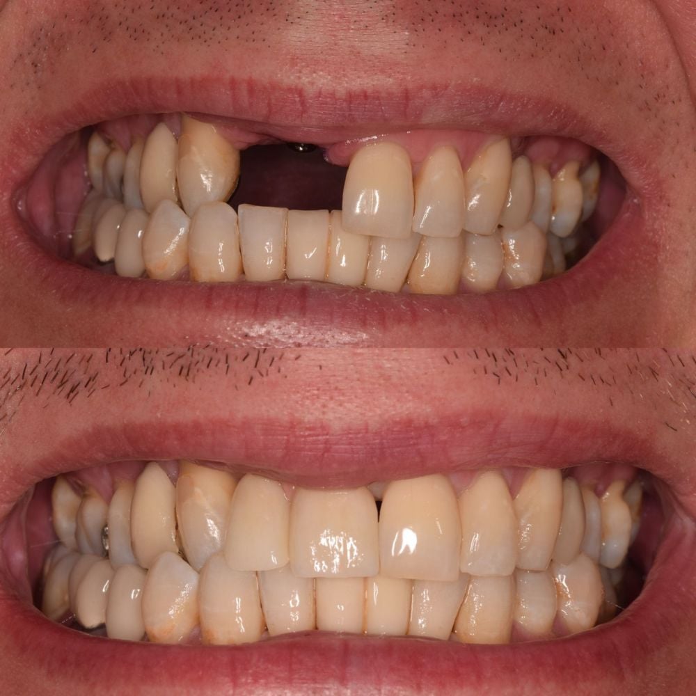 Before and after treatment at St Andrews Dental Care in Fife
