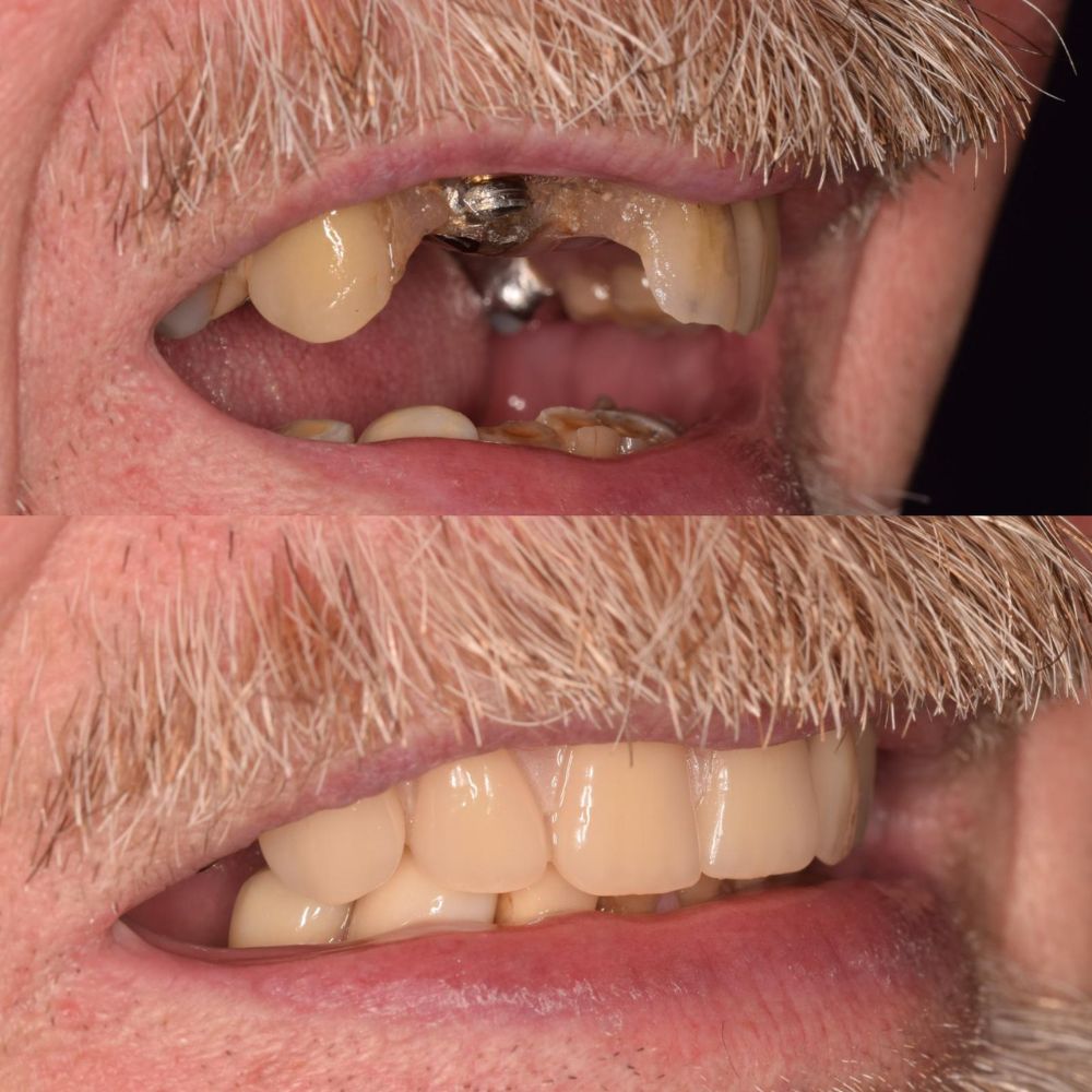 Before and after treatment at St Andrews Dental Care in Fife