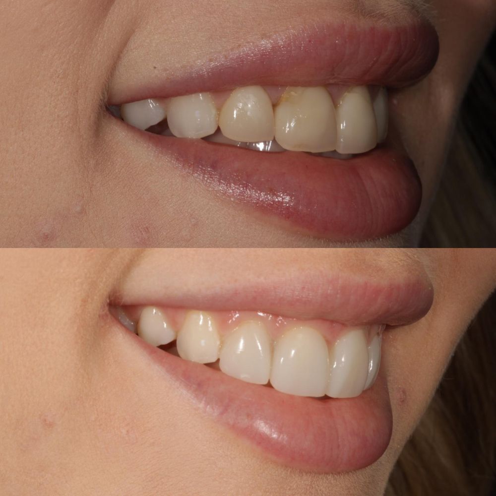 Before and after treatment at St Andrews Dental Care in Fife