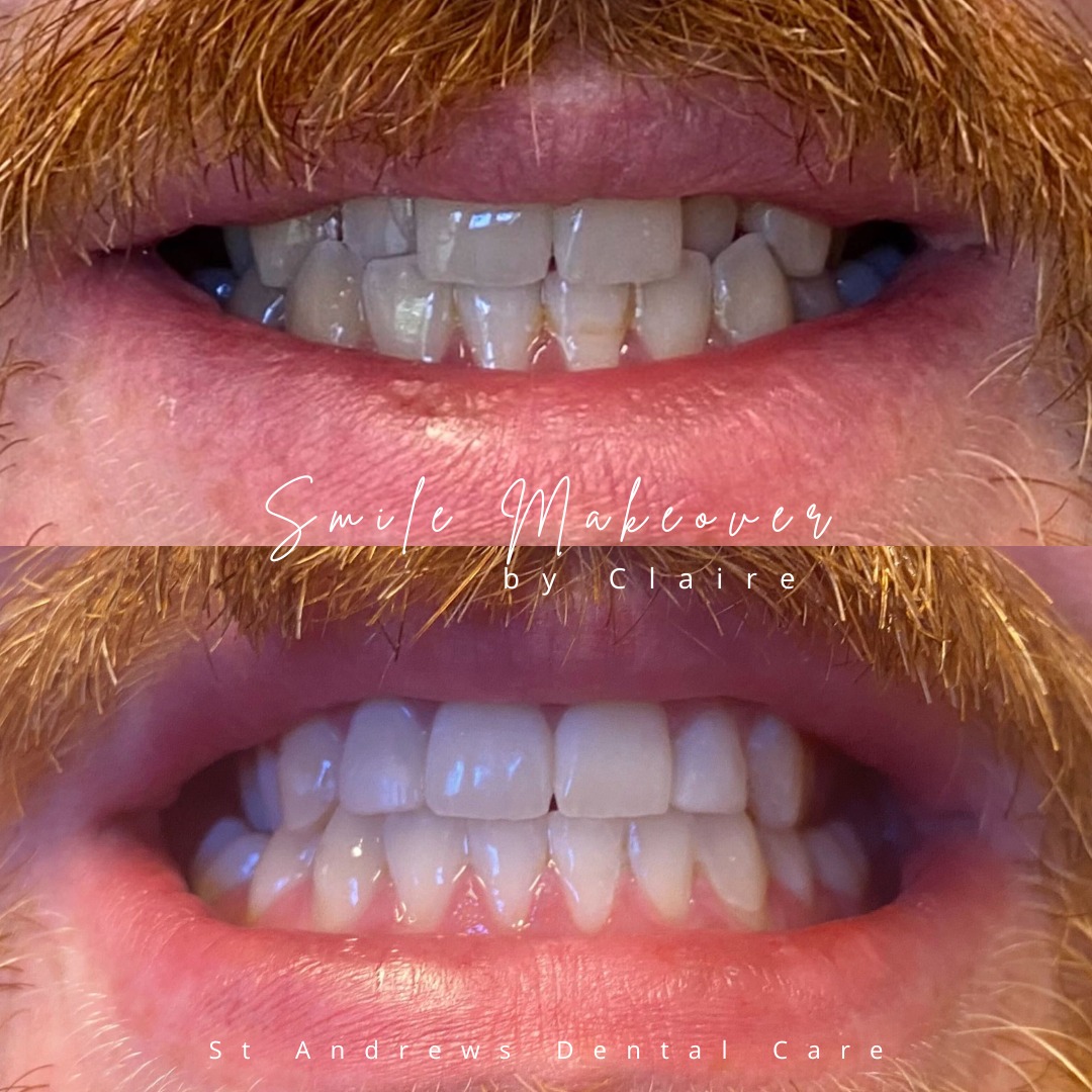 St Andrews Dental Care | Smile Makeovers Before and after treatment at St Andrews Dental Care