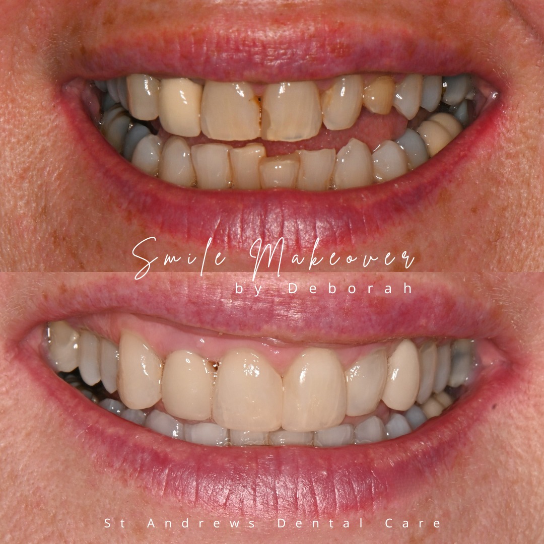 St Andrews Dental Care | Smile Makeovers Before and after treatment at St Andrews Dental Care