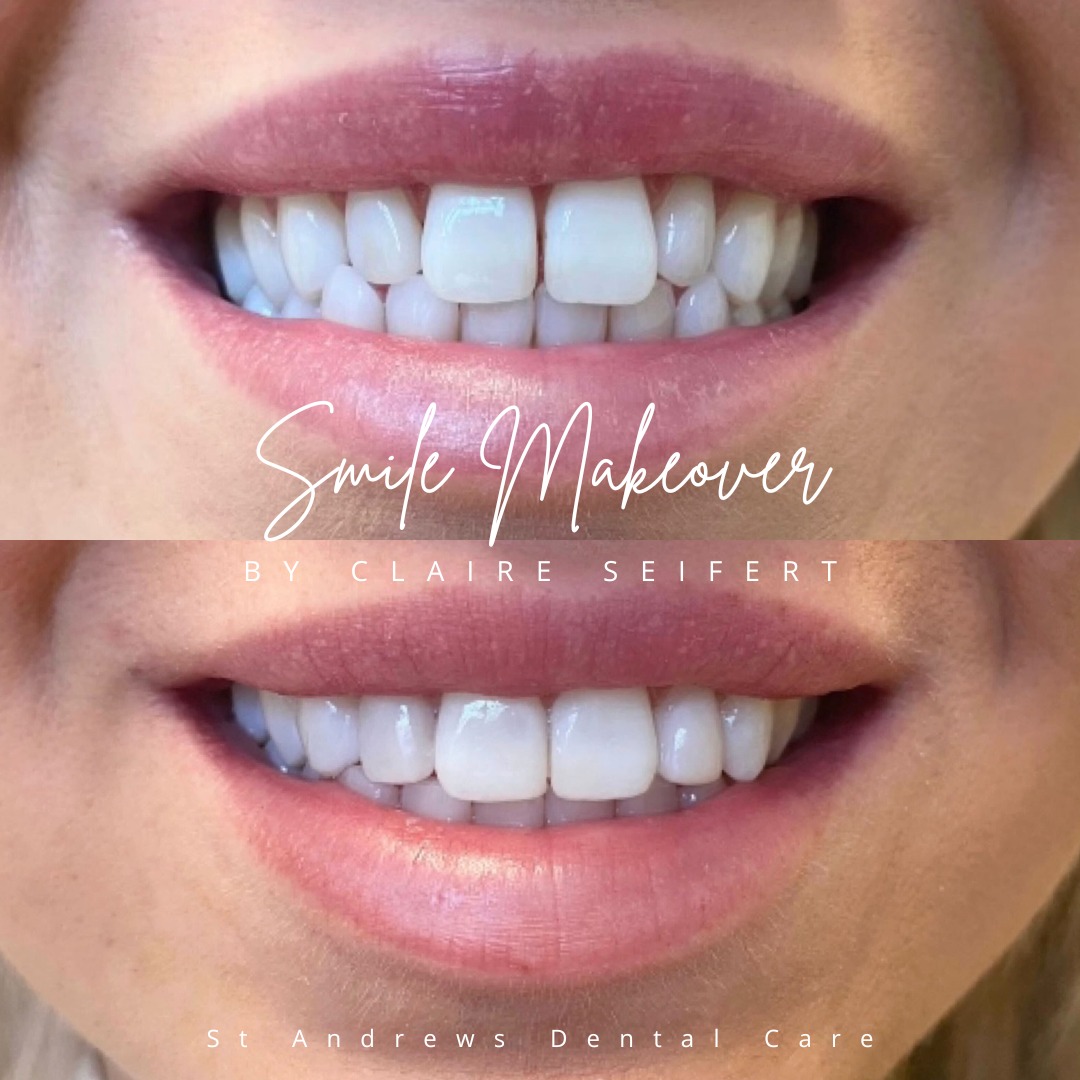 St Andrews Dental Care | Smile Makeovers Before and after treatment at St Andrews Dental Care