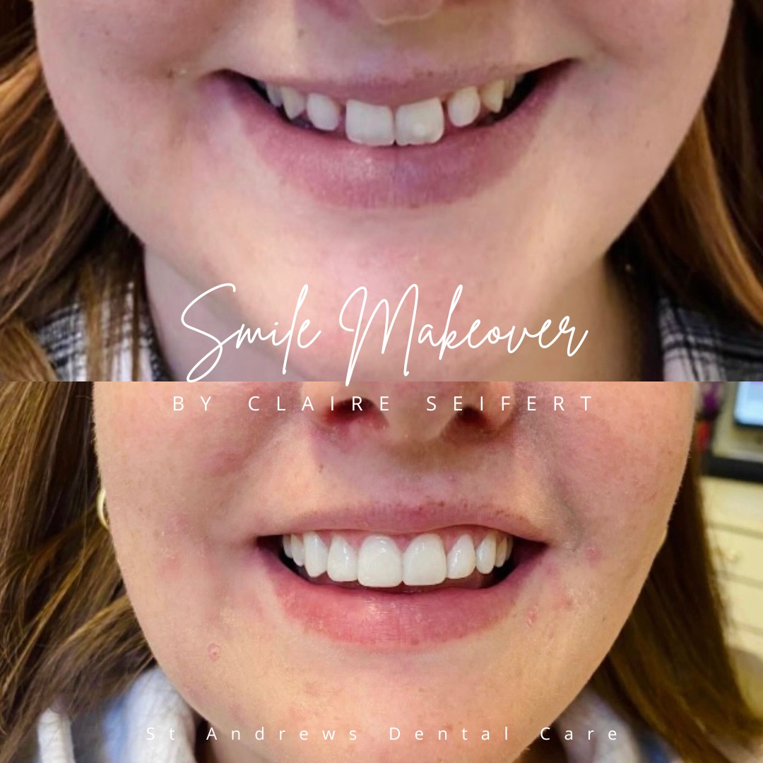 St Andrews Dental Care | Smile Makeovers Before and after treatment at St Andrews Dental Care