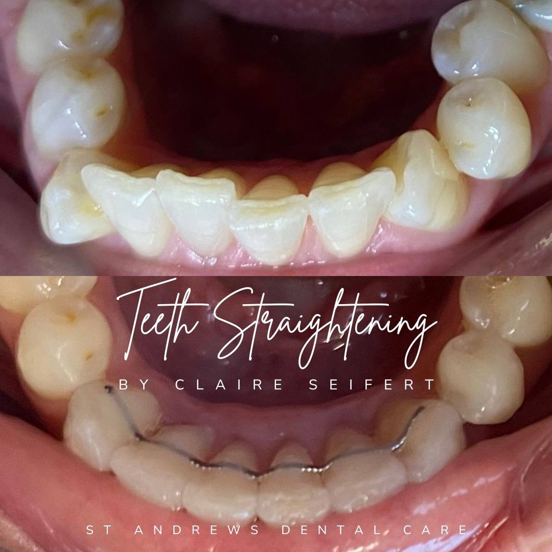 Before and after treatment at St Andrews Dental Care in Fife