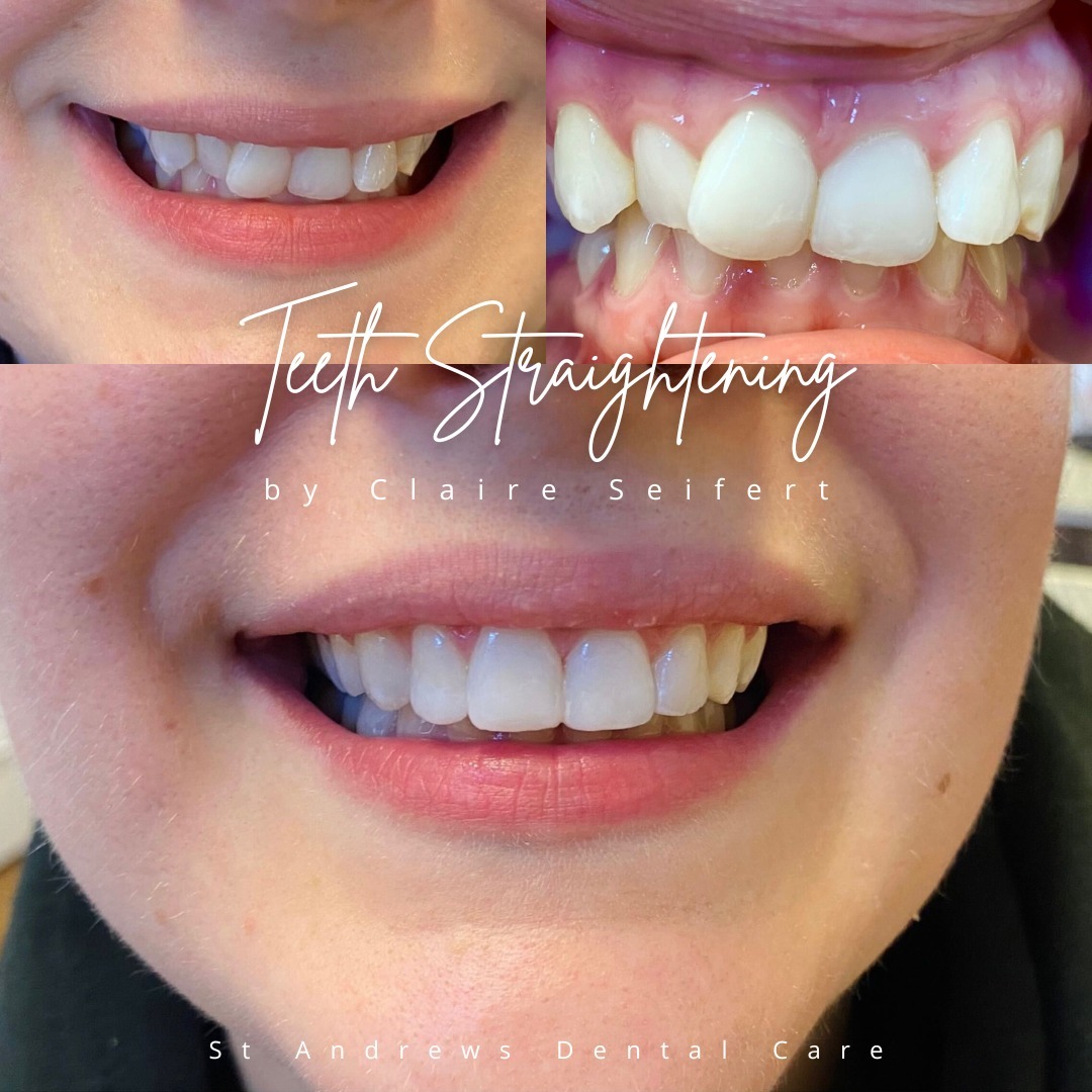 Before and after treatment at St Andrews Dental Care in Fife