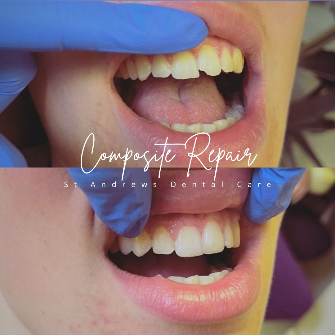 5 Reasons Patients Choose Composite Bonding