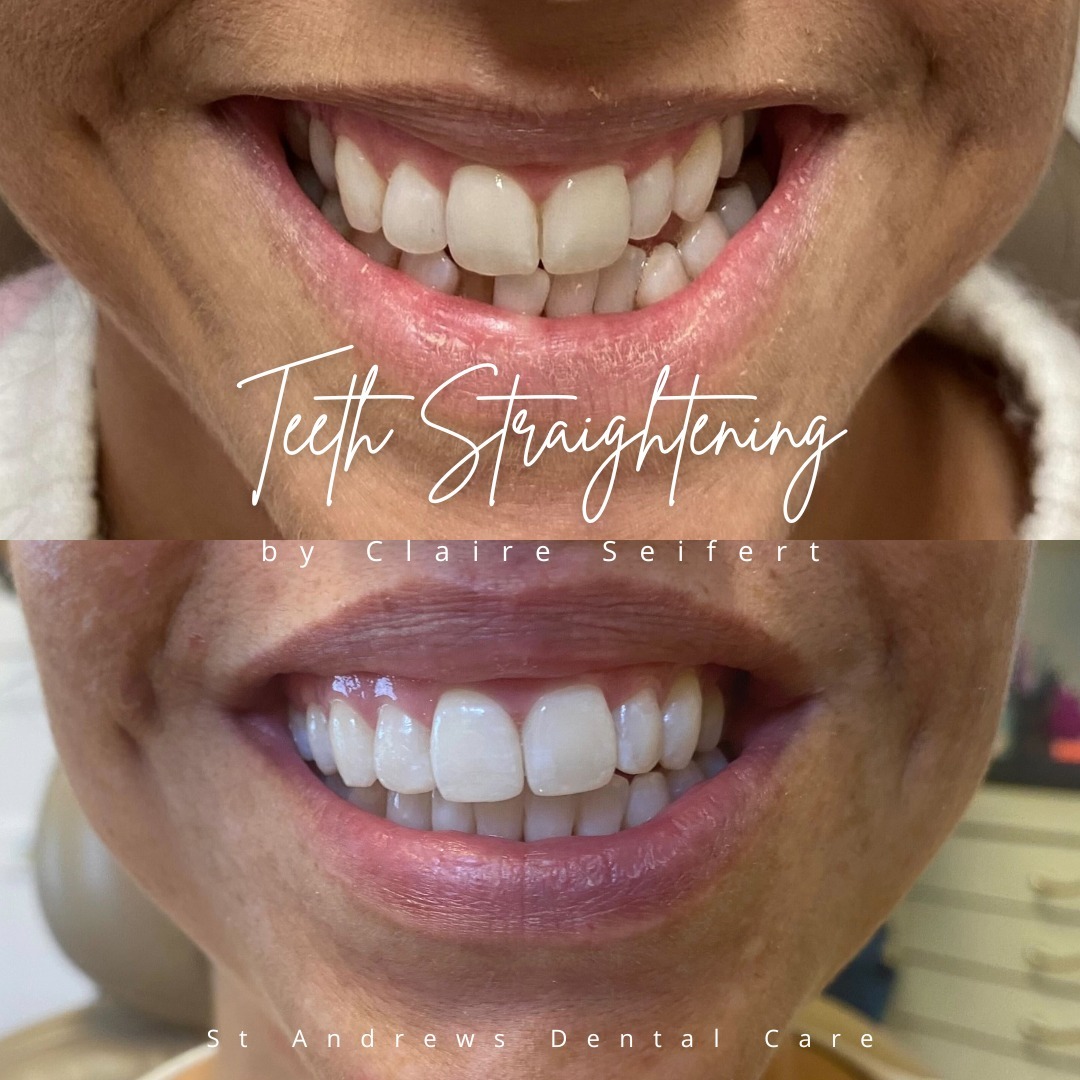 Before and after treatment at St Andrews Dental Care in Fife