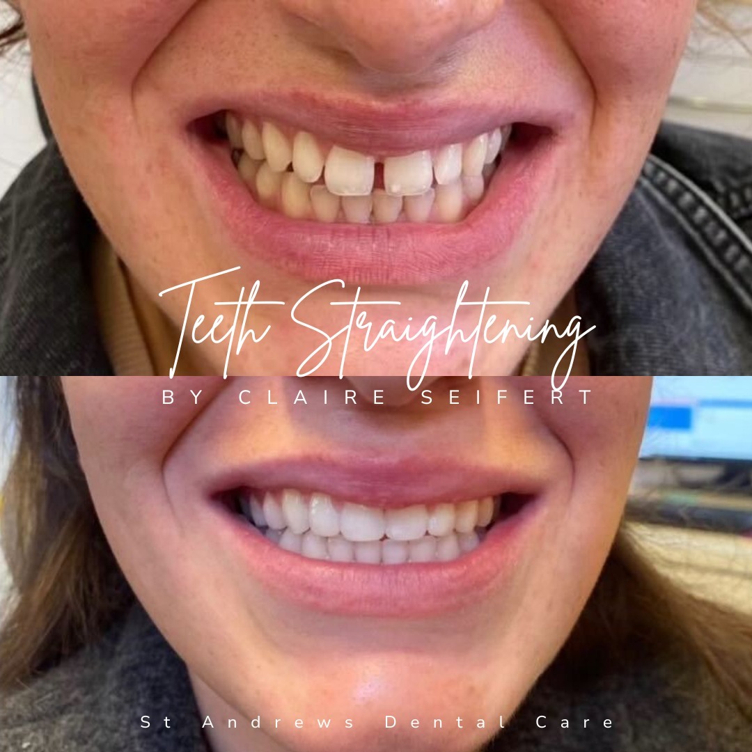 Before and after treatment at St Andrews Dental Care in Fife