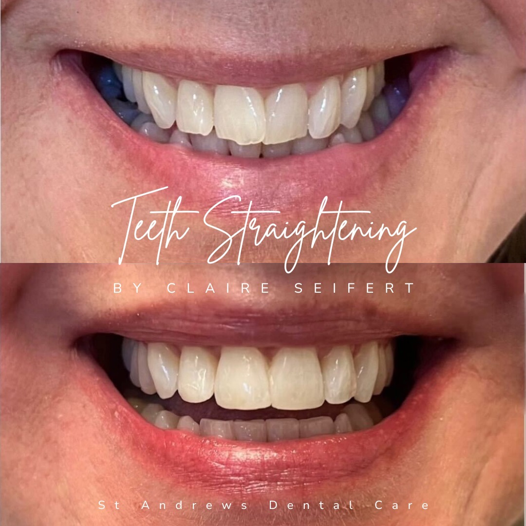Before and after treatment at St Andrews Dental Care in Fife