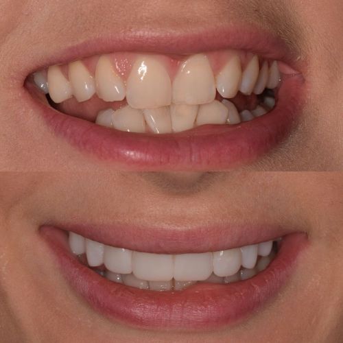 Before and after treatment at St Andrews Dental Care in Fife