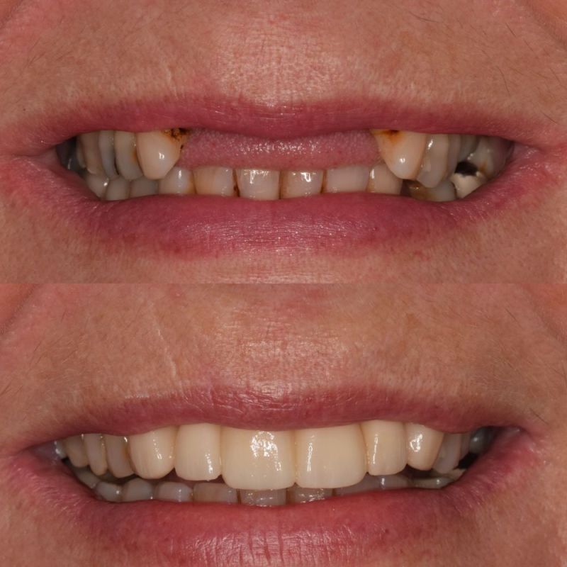 St Andrews Dental Care | Dental Implants Fife Replace Missing Teeth