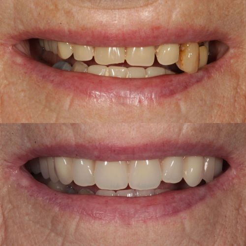 Before and after treatment at St Andrews Dental Care in Fife