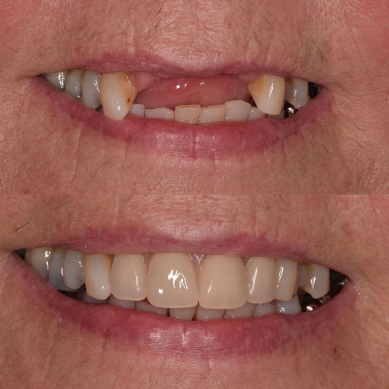 St Andrews Dental Care | Dental Implants Fife Replace Missing Teeth