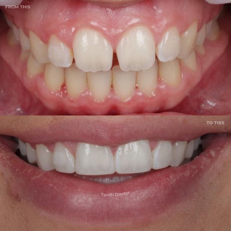 What Is Composite Bonding?